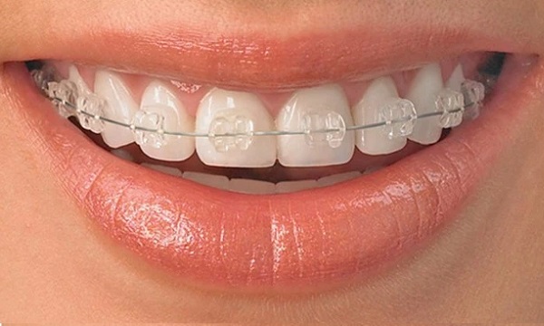 aparat dentar estetic safir fix
